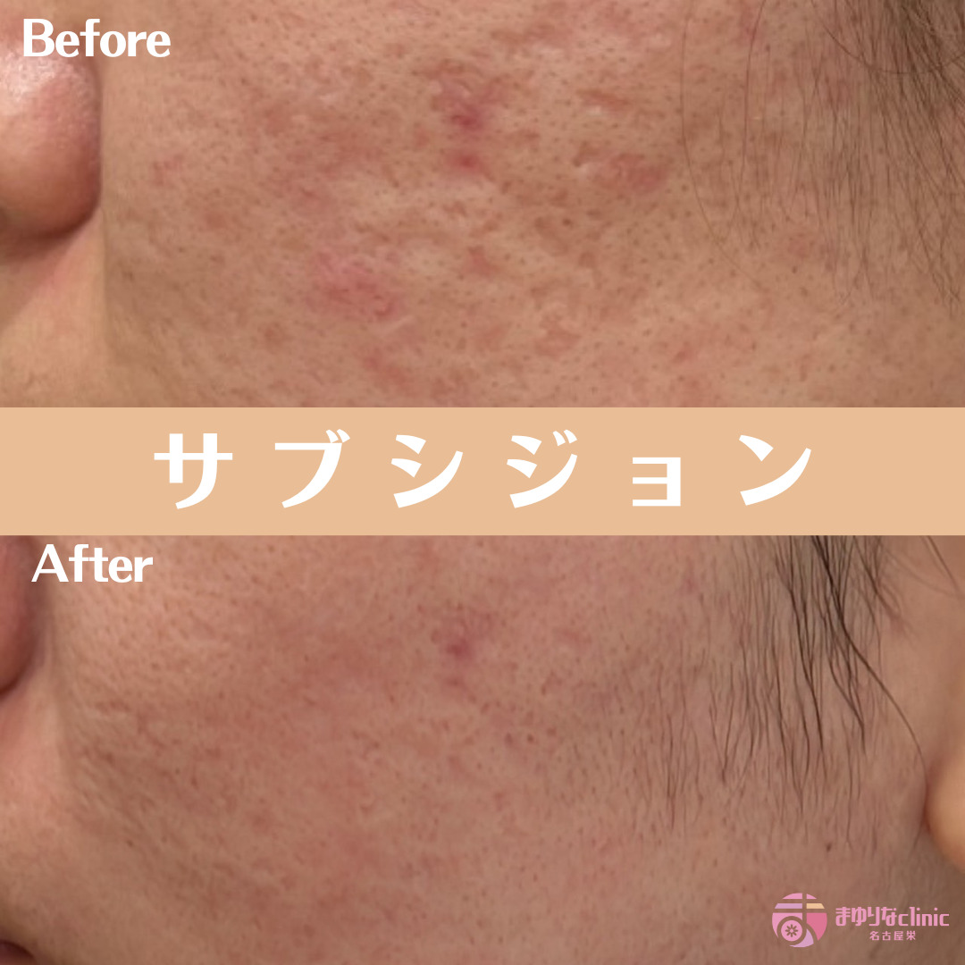 サブシジョン+非架橋ヒアルロン酸の治療前後写真
