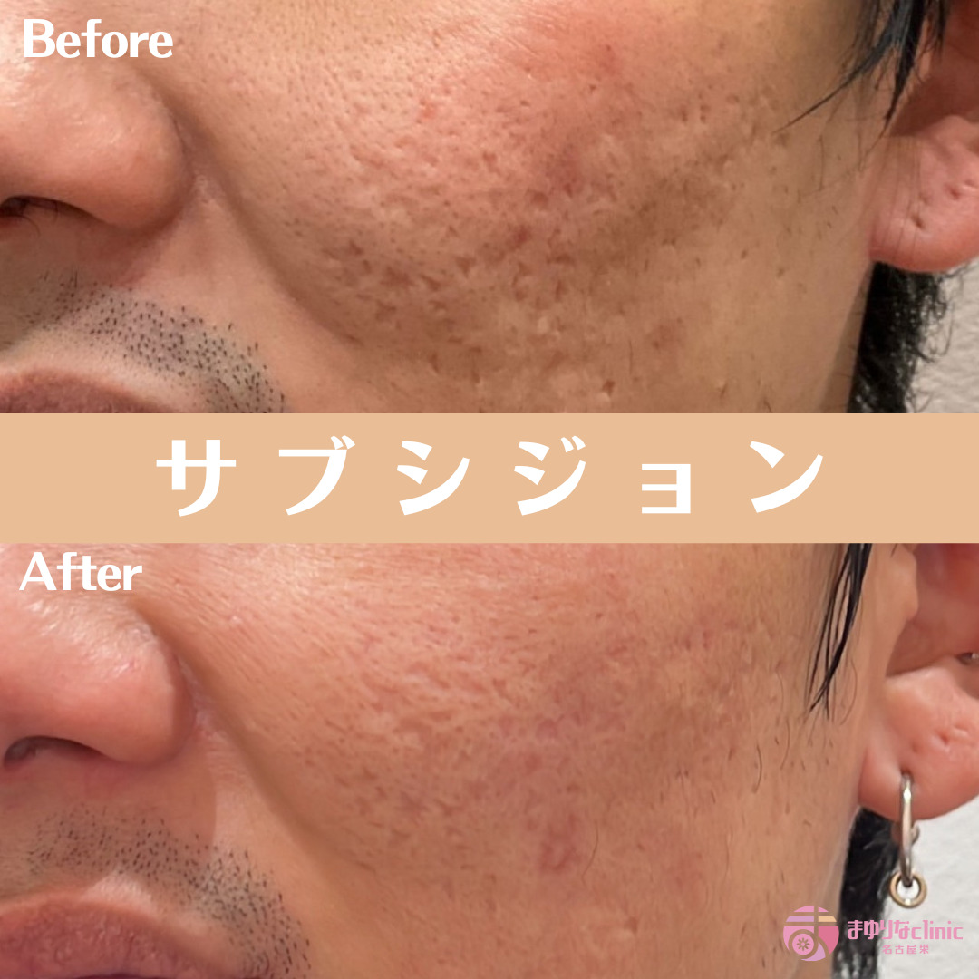 サブシジョン+ジュベルックの治療前後写真