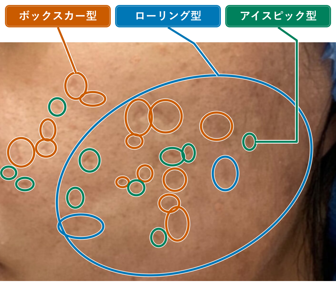 クレーターの混在を説明する図。青はローリング型、オレンジはボックスカー型、緑はアイスピック型。各ネームタグから代表の囲みへ線をつないでいます。