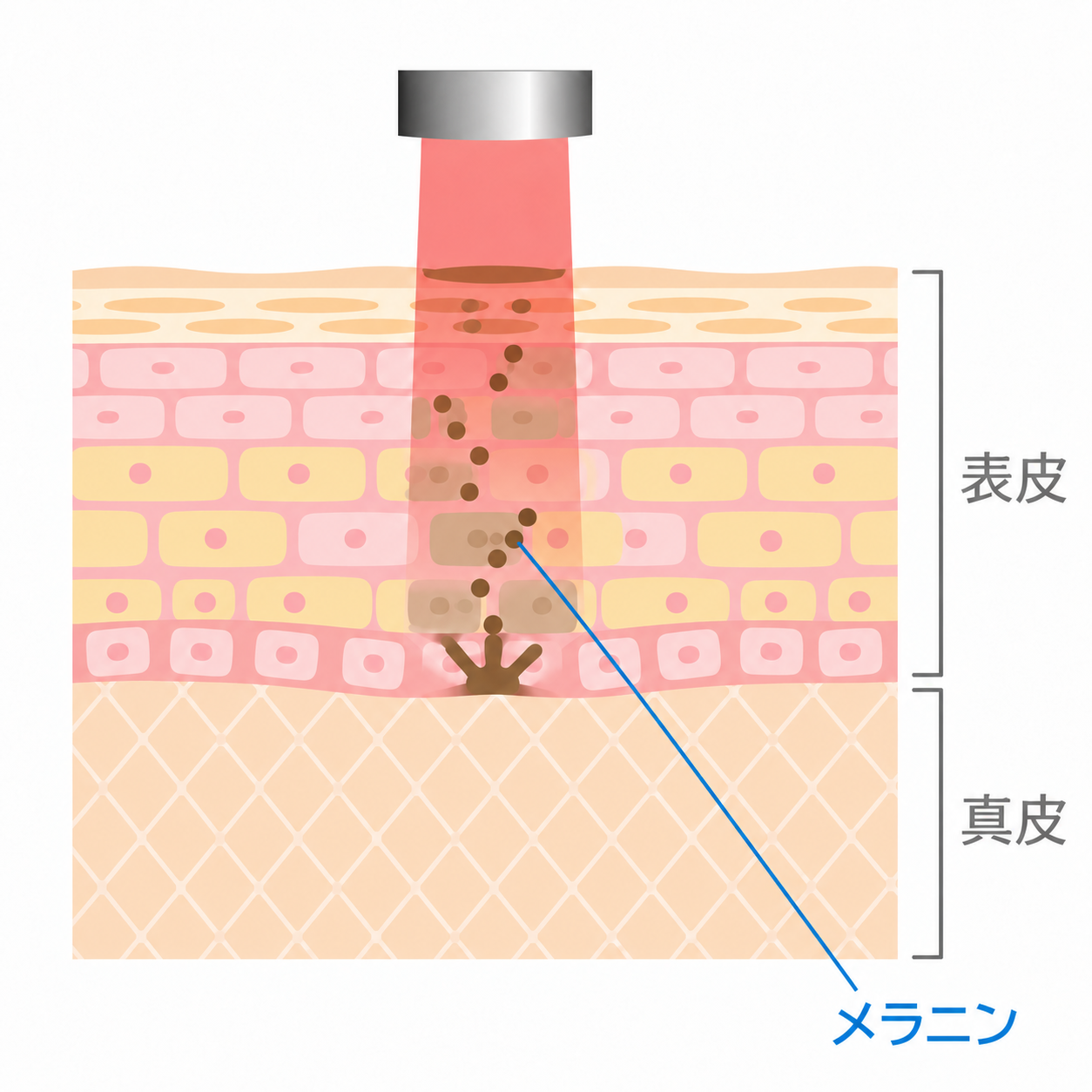 ピコスポットの照射方法のイメージ(模式図)。色素斑に絞った赤いレーザーを、表皮と真皮の境目付近まで描写。表皮内の中央に集まるメラニンと表皮・真皮の位置を表示。光の色・広がり・深さ、皮膚の厚さは説明用で、実際の縮尺とは異なります。