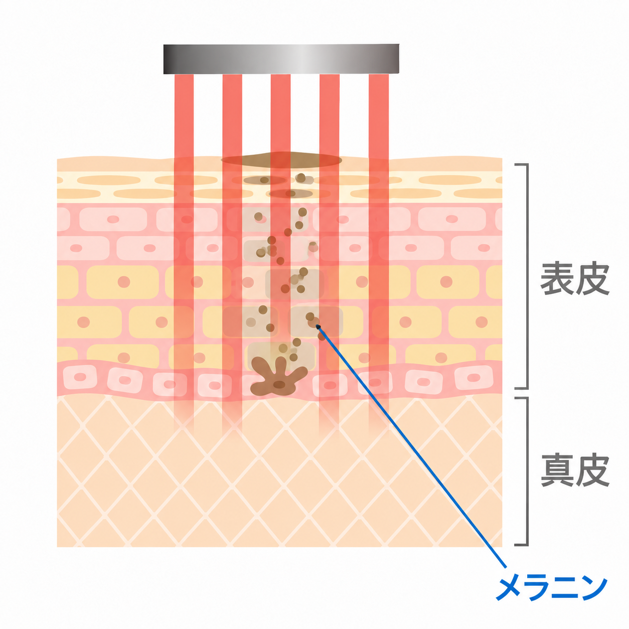 ルビーフラクショナルの照射方法のイメージ(模式図)。細かな点状の赤いレーザーを、真皮浅層付近まで描写。表皮内の中央に集まるメラニンと表皮・真皮の位置を表示。光の色・広がり・深さ、皮膚の厚さは説明用で、実際の縮尺とは異なります。