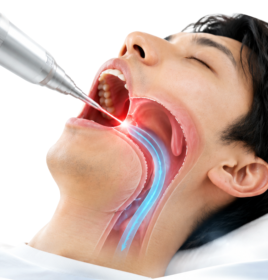 レーザー治療のイメージ