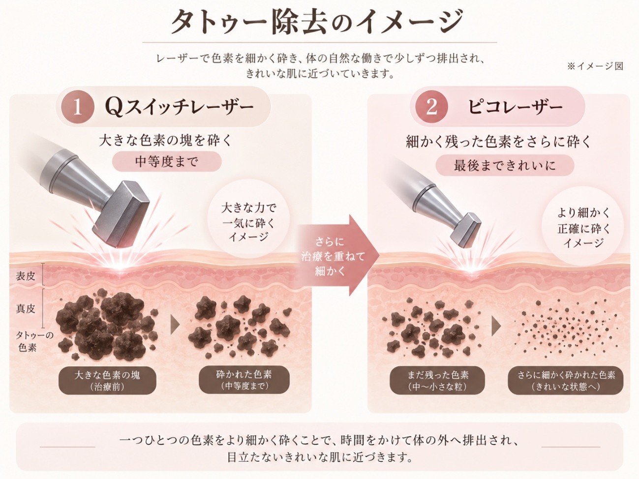 レーザーで色素を細かく砕くタトゥー除去のイメージ