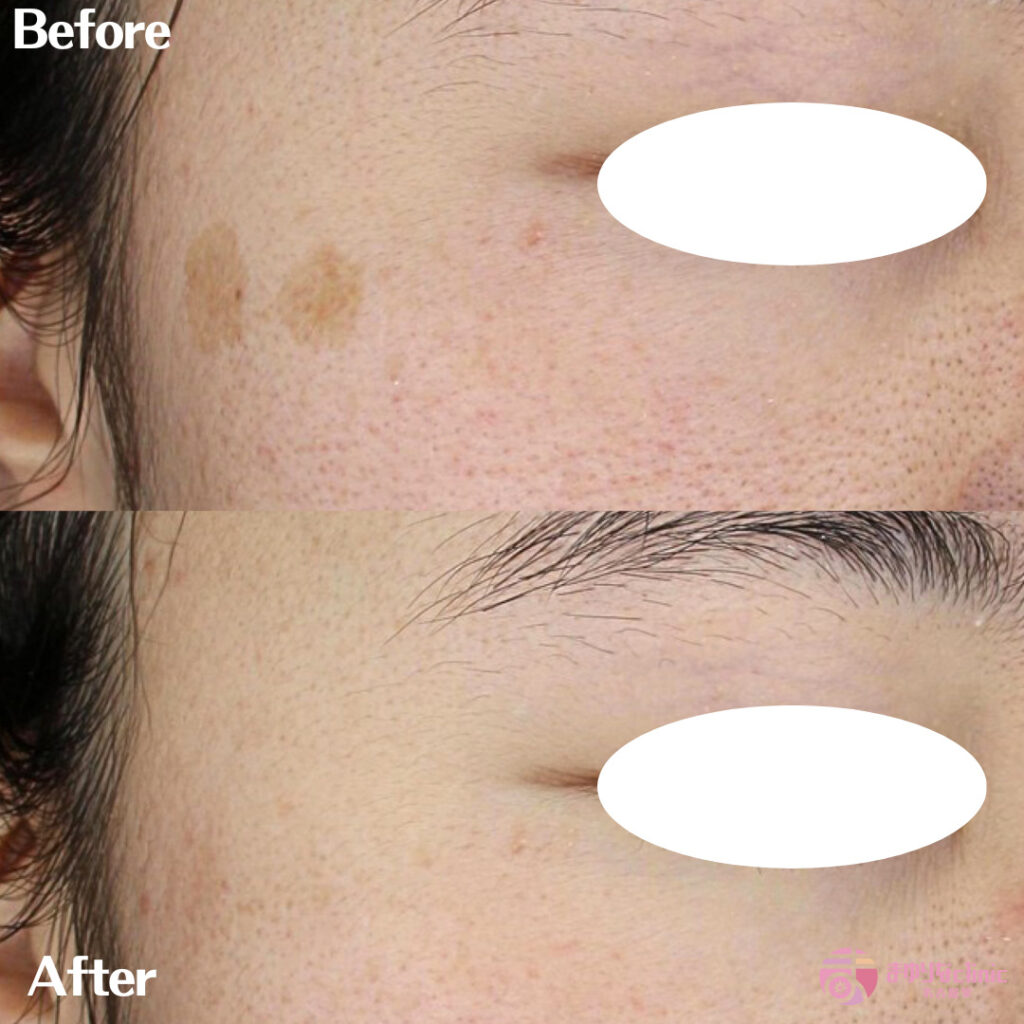 【シミ取り】ピコスポット | まゆりなclinic名古屋栄｜名古屋栄の美容皮膚科