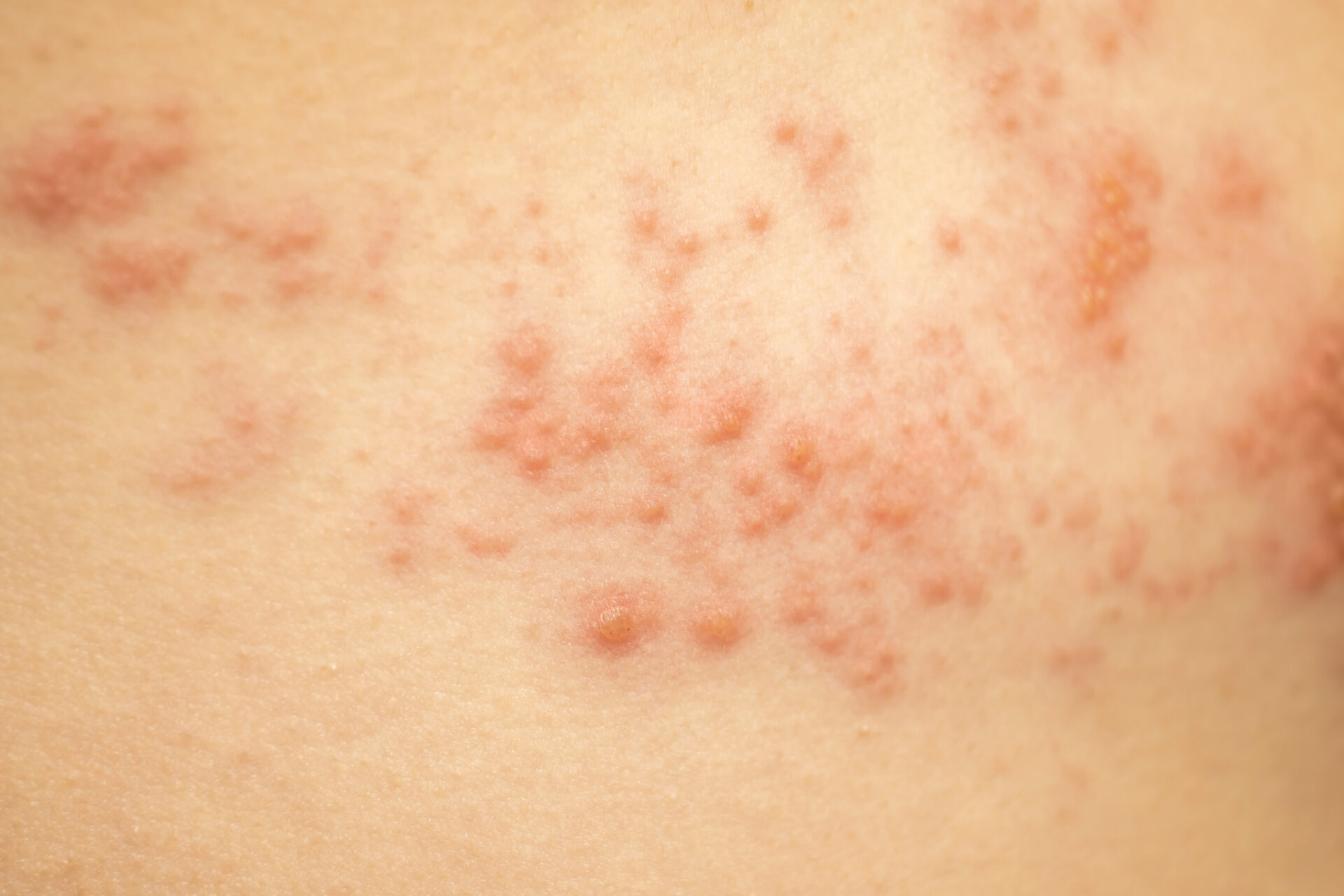 帯状疱疹と蕁麻疹の写真