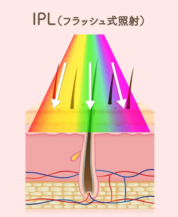 フラッシュ式脱毛器