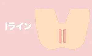 Iライン