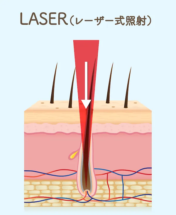レーザー式脱毛器