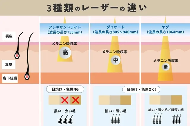 脱毛機3種のレーザー