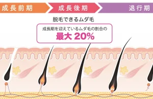 脱毛できるムダ毛はたったの20%