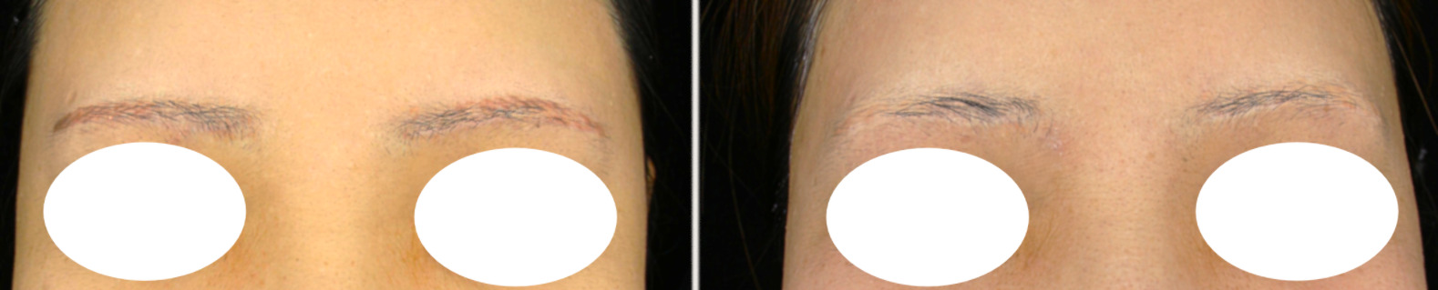 アートメイク除去　症例