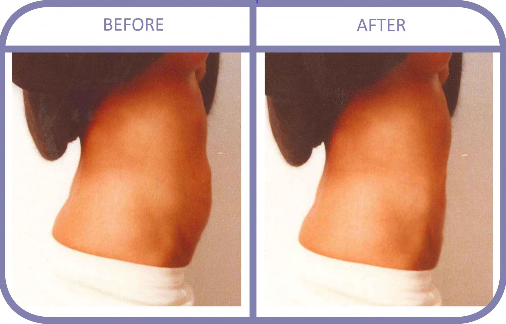 ダイエット注射　症例　ミケランジェロ注射