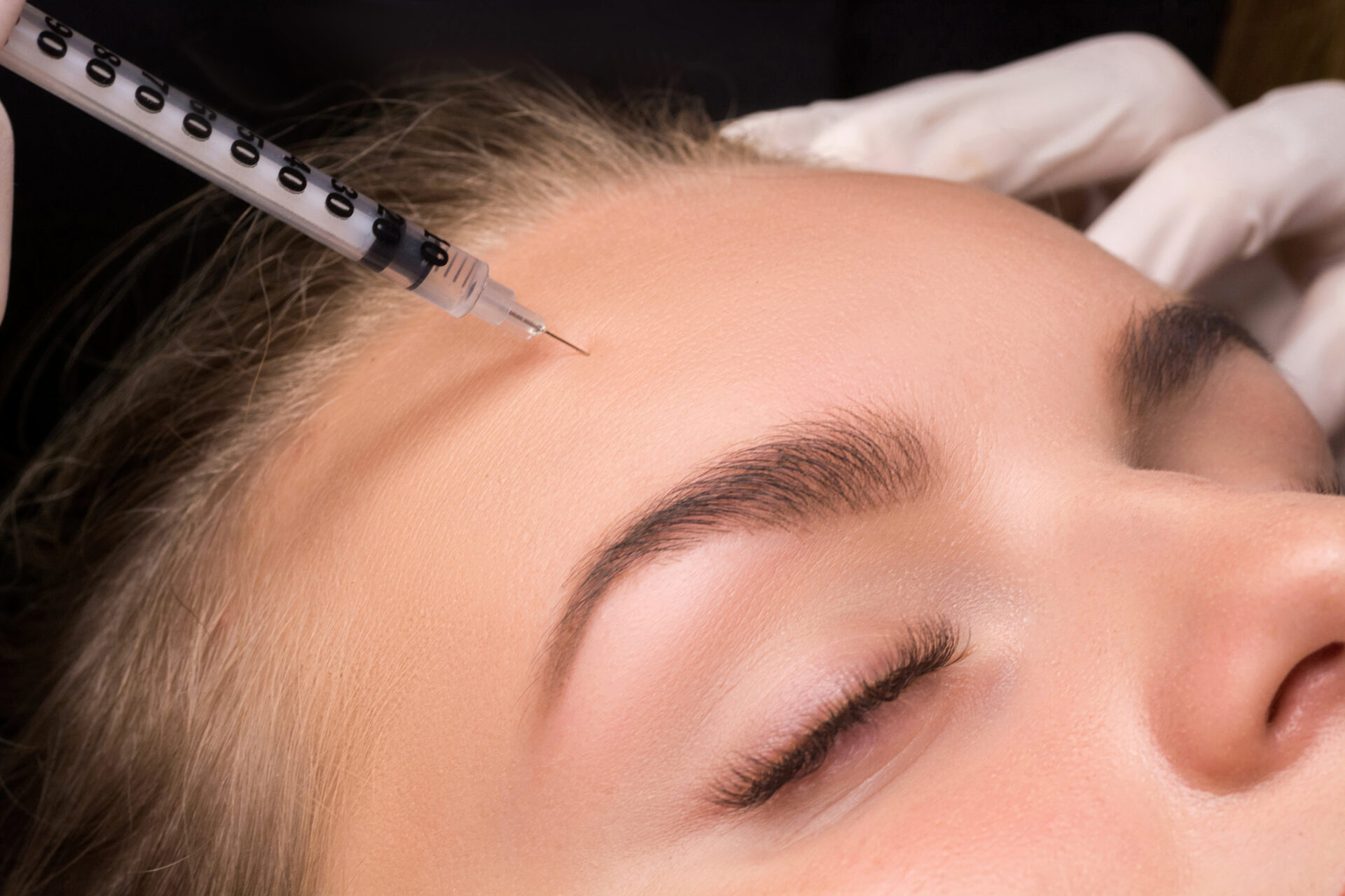 ヒアルとボトックスのいいとこ取り!?CGスタイラーの魅力を徹底解説【医師監修】