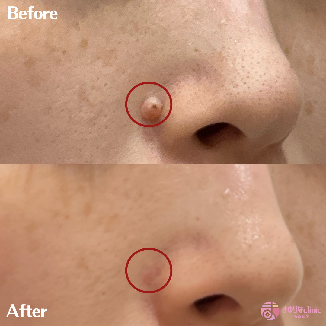 CO2レーザー ほくろ除去 症例