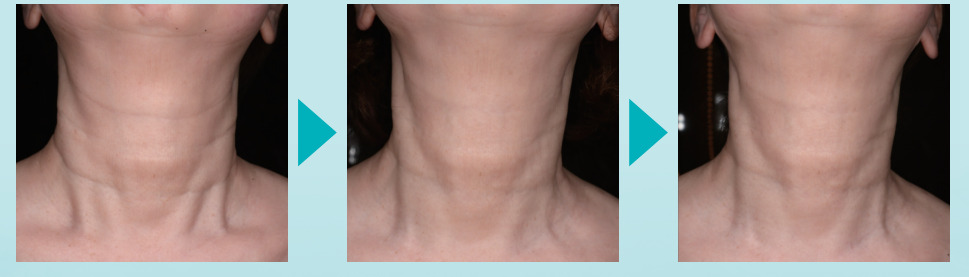 スキンバイブ　症例