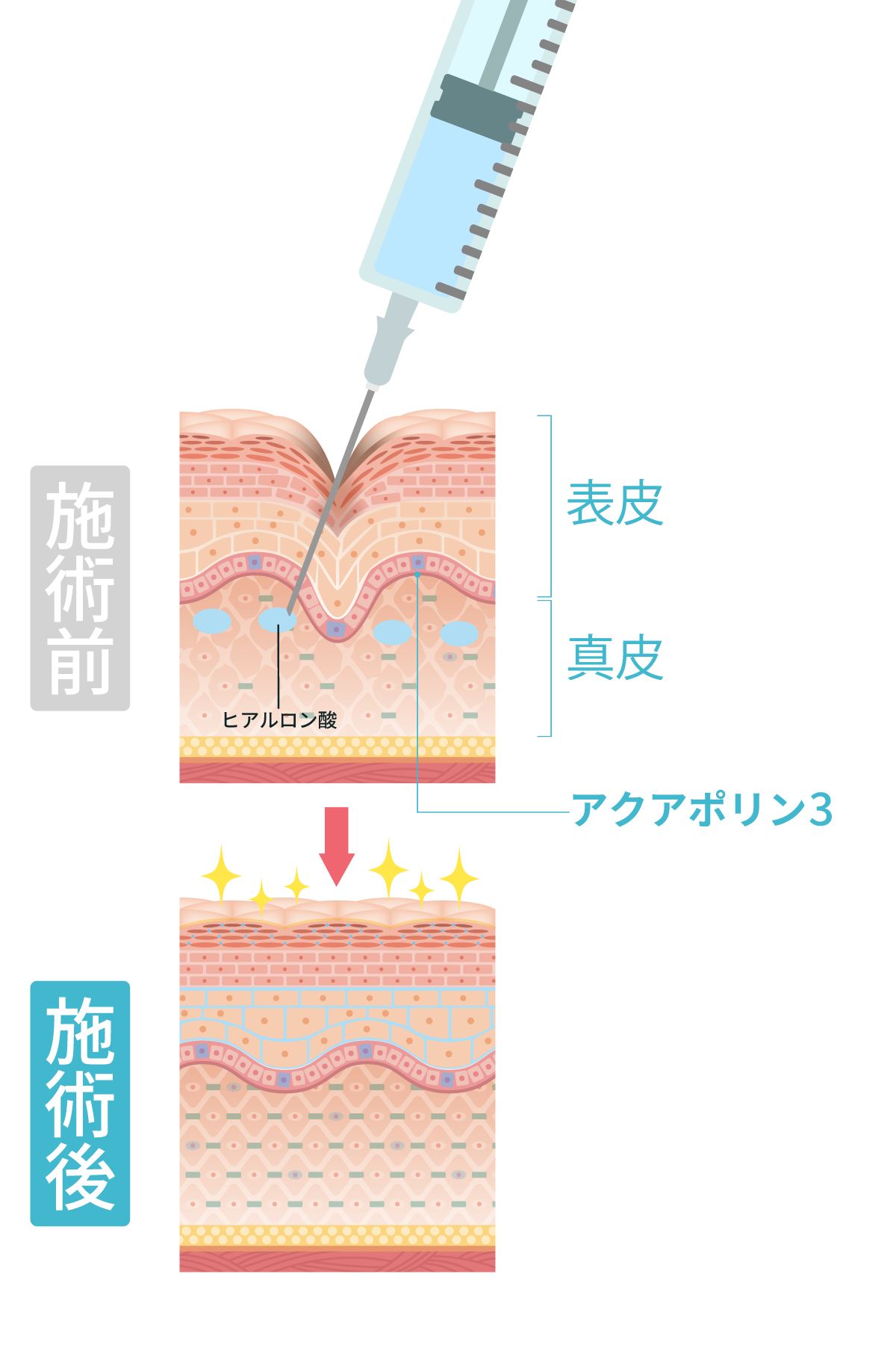 スキンバイブ 真皮注入 断面図