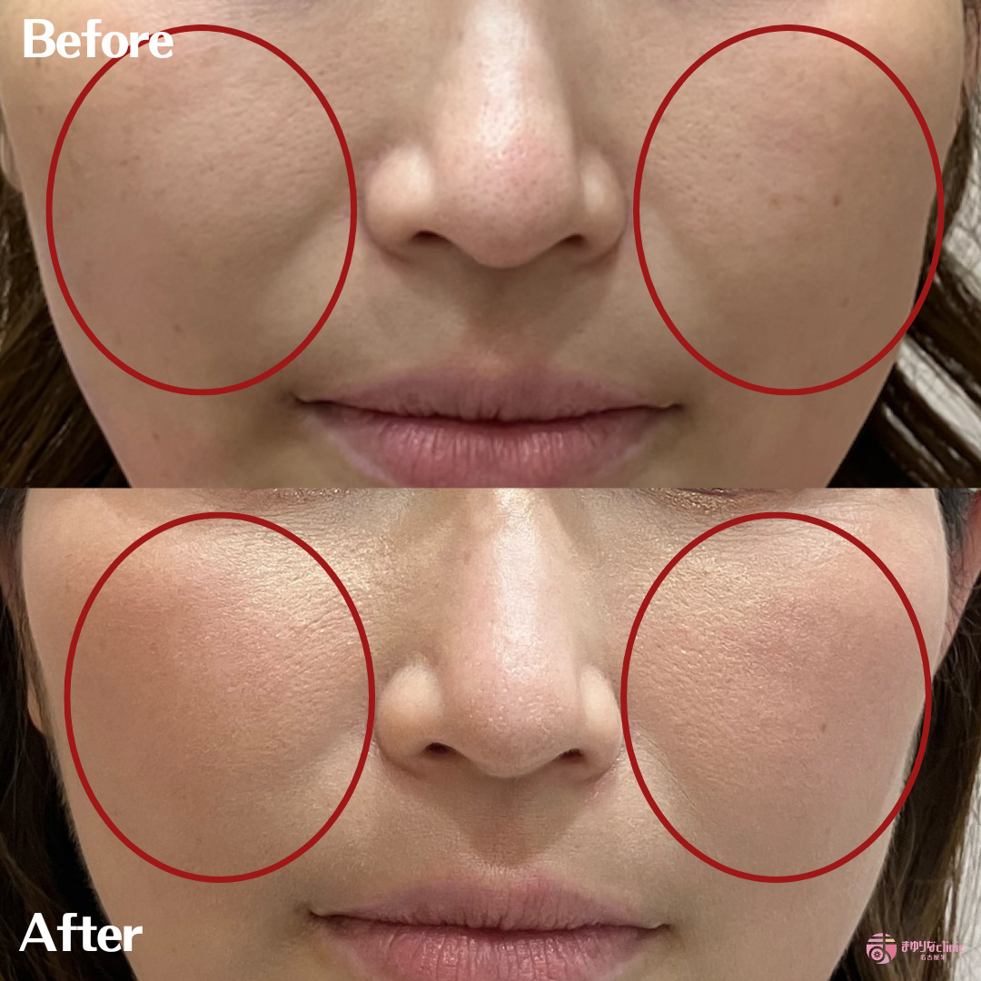 アッティバ　症例