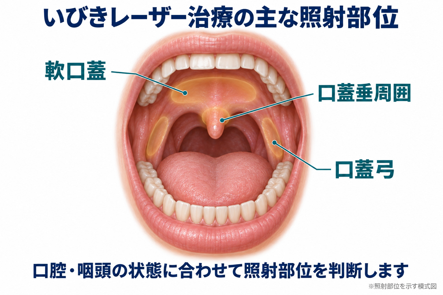 いびきのレーザー治療で確認する軟口蓋、口蓋垂周囲、口蓋弓などの位置