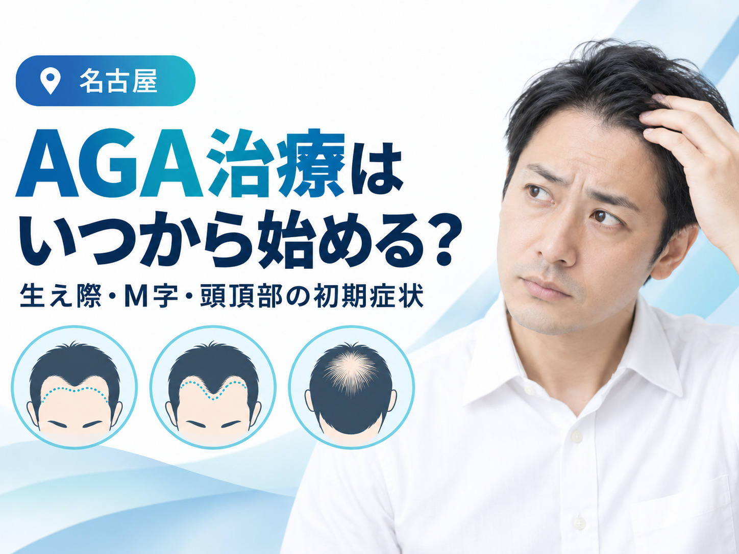 AGA治療はいつから始める？生え際・M字・頭頂部の初期症状│名古屋