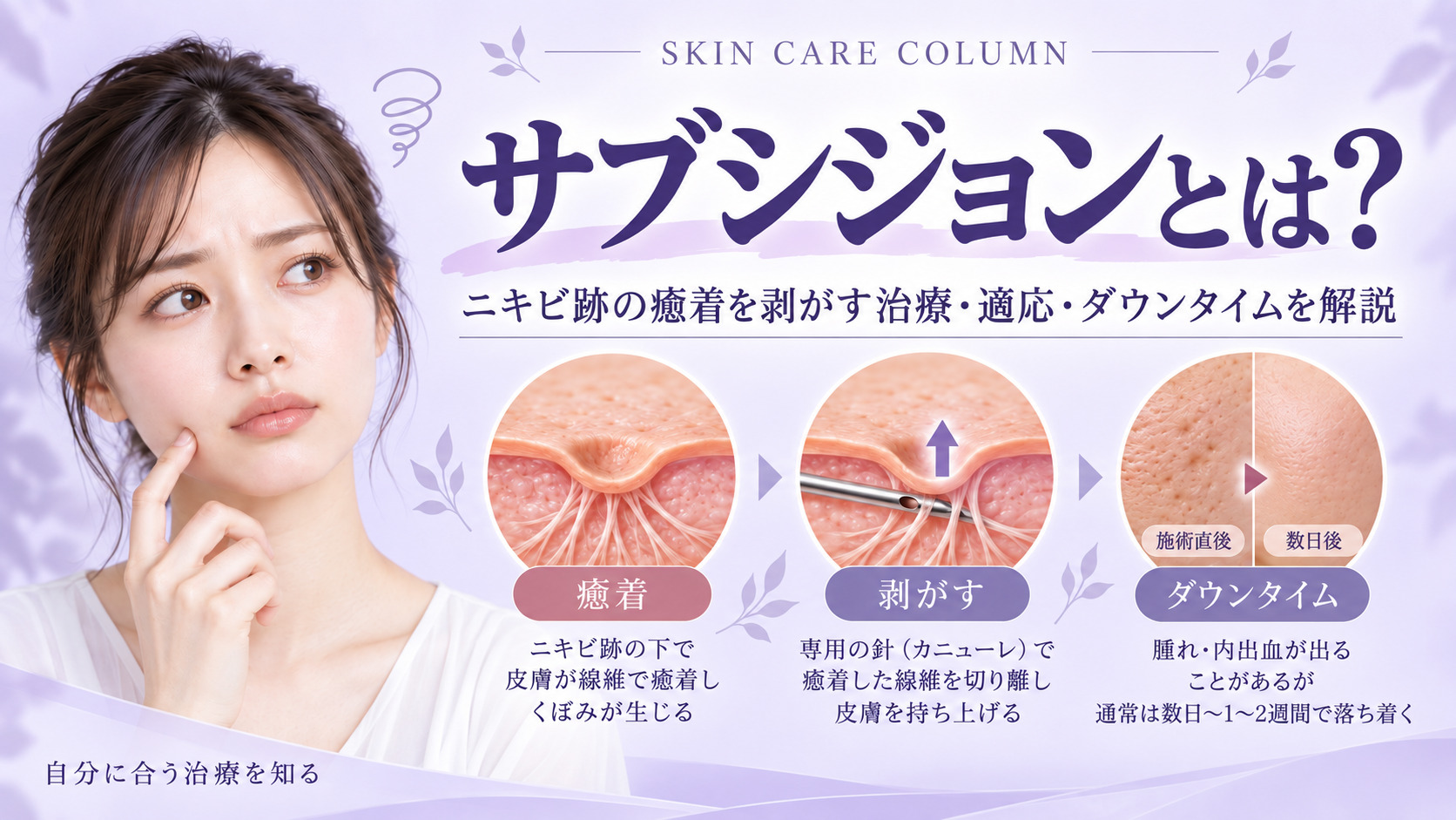 サブシジョンとは?ニキビ跡の癒着を剥がす治療・適応・ダウンタイムを解説|名古屋