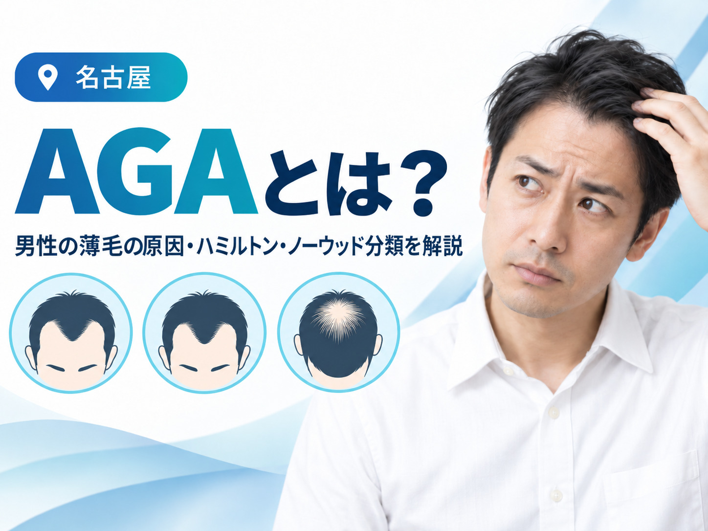 男性AGAとは？男性の薄毛の原因・ハミルトン・ノーウッド分類を解説｜名古屋