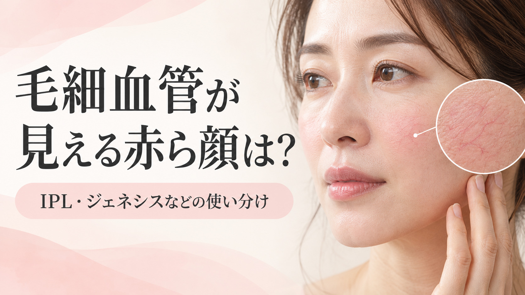 毛細血管が見える赤ら顔はどう治療する?IPL・レーザーの選び方|名古屋