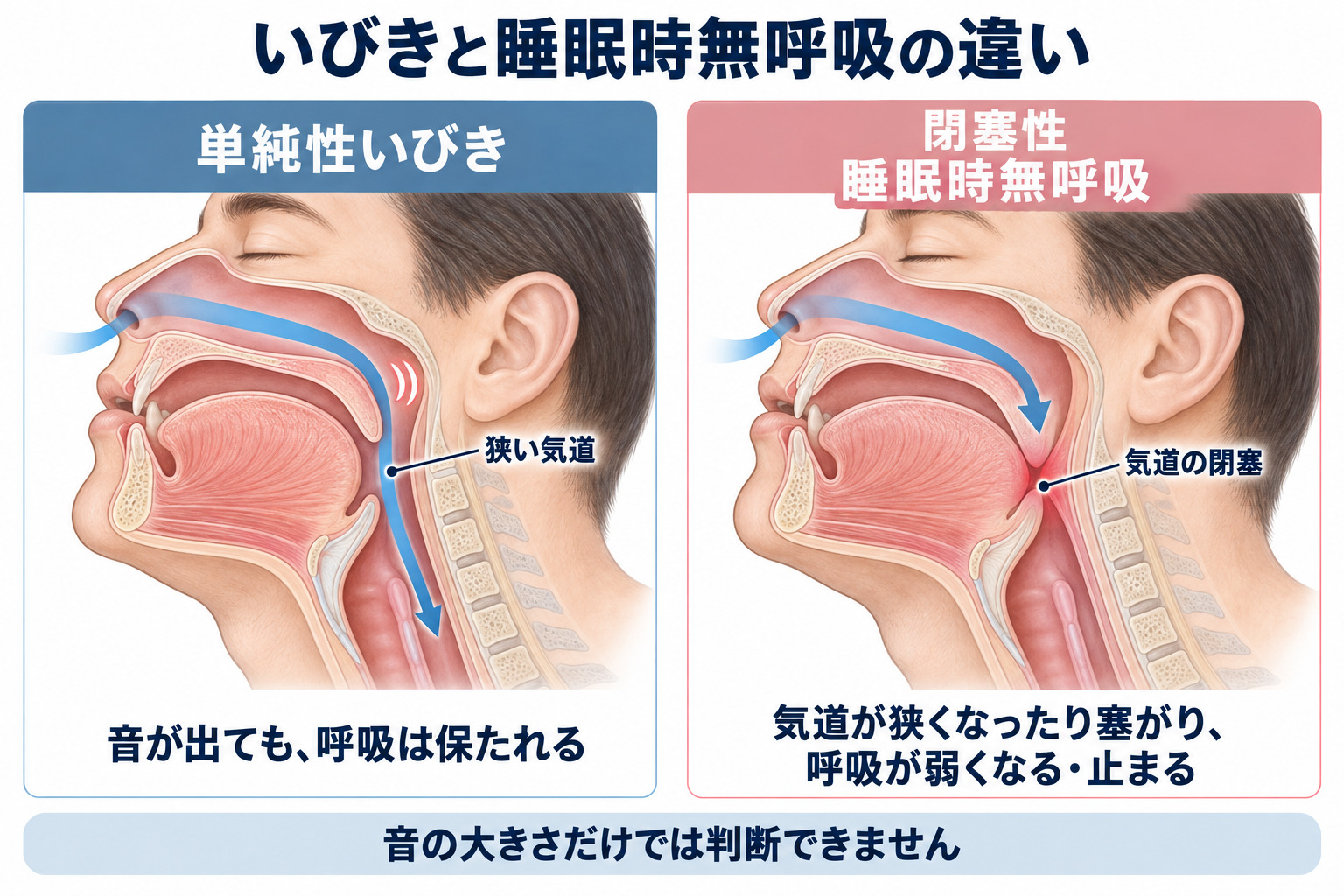 単純性いびきと閉塞性睡眠時無呼吸の気道を比較する図
