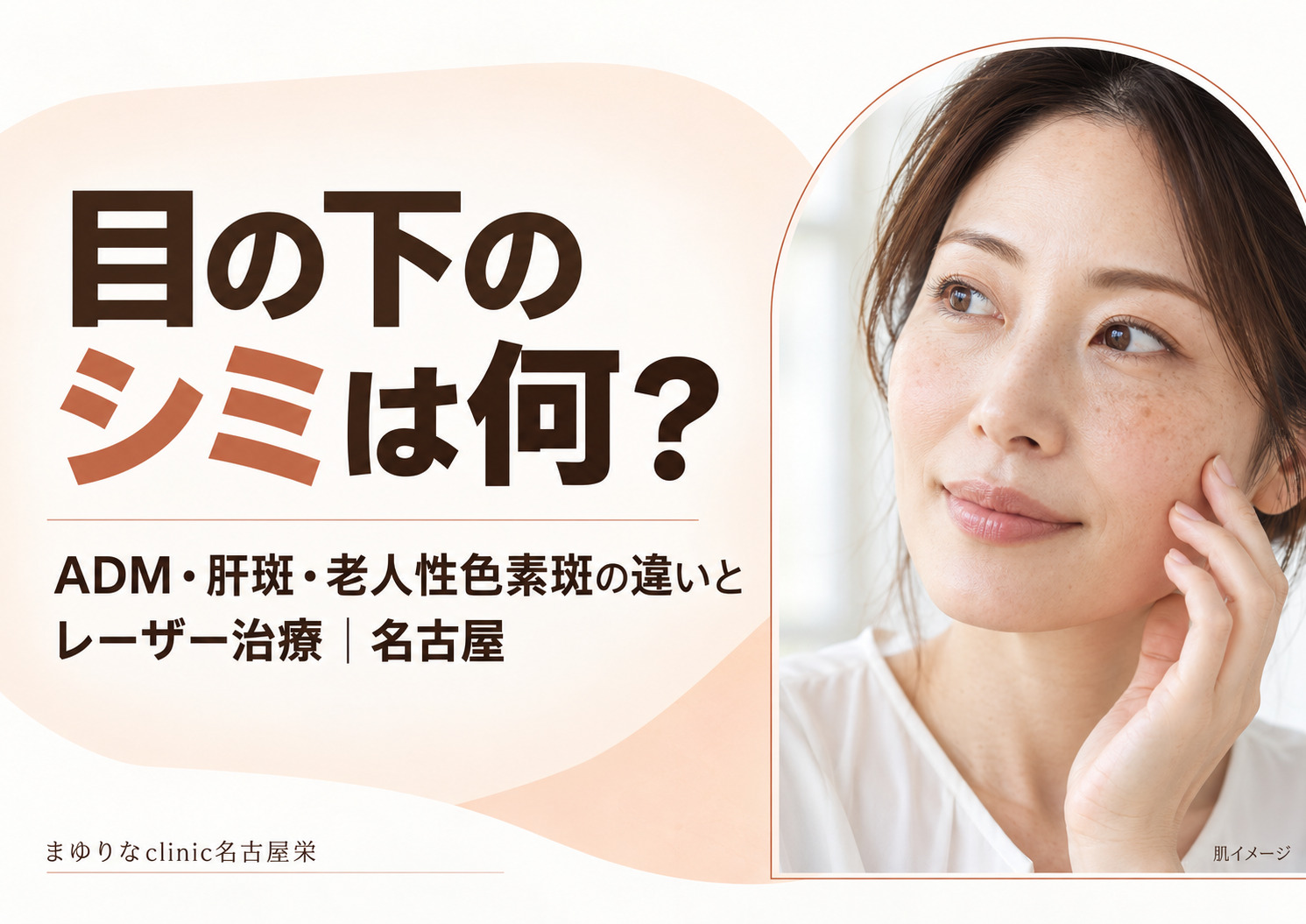 目の下のシミは何?ADM・肝斑・老人性色素斑の違いとレーザー治療|名古屋