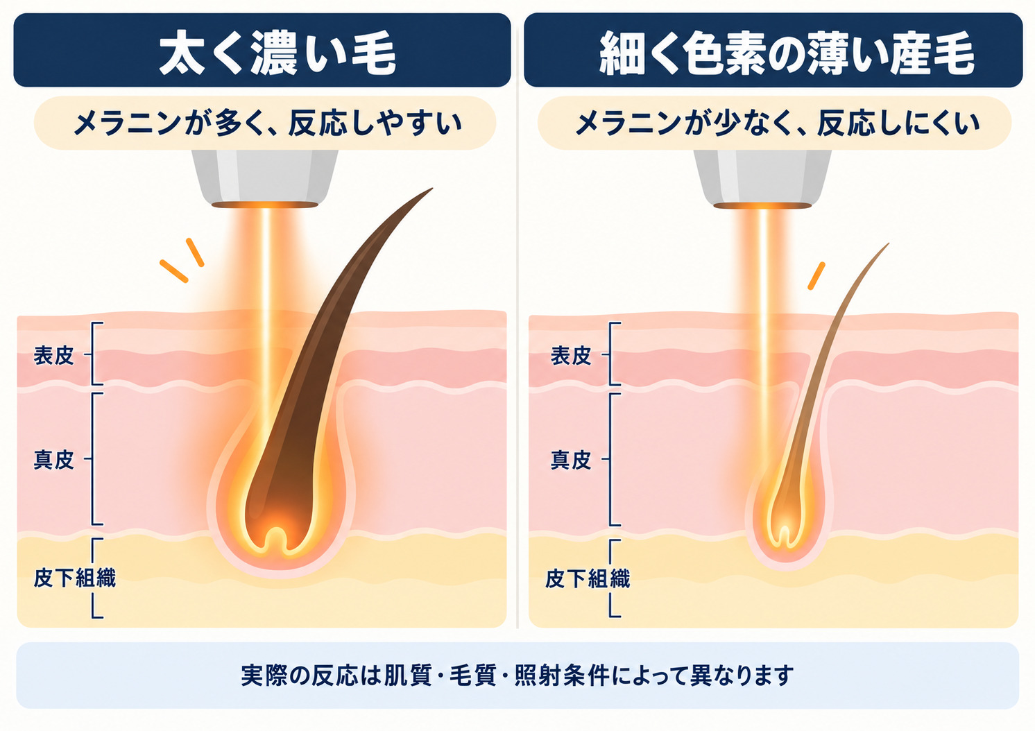 顔の産毛はなぜ脱毛しにくい?太い毛とのレーザー反応の違い 医療レーザー脱毛で太く濃い毛と細く色素の薄い顔の産毛では反応のしやすさが異なることを示した皮膚断面の模式図