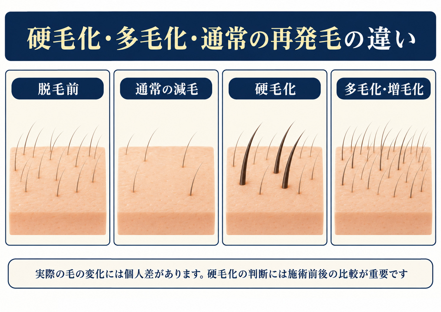 脱毛前・通常の減毛・硬毛化・多毛化を比較する模式図 皮膚上の毛を「脱毛前」「通常の減毛」「硬毛化」「多毛化・増毛化」の4区画で比較。毛の本数や太さの違いを描き、下部に個人差と施術前後の比較に関する注意書きがある。