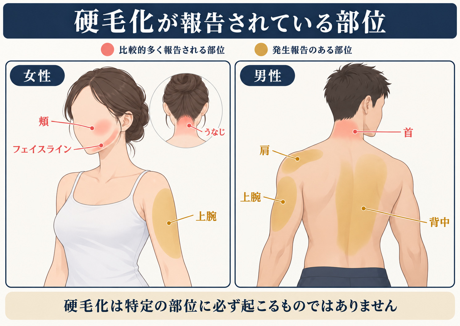 硬毛化が報告されている部位を男女別に示す図 女性の頬・フェイスライン・うなじ、男性の首を赤色、女性の上腕と男性の肩・上腕・背中を黄色で表示。赤は比較的多く報告される部位、黄は発生報告のある部位を示す。