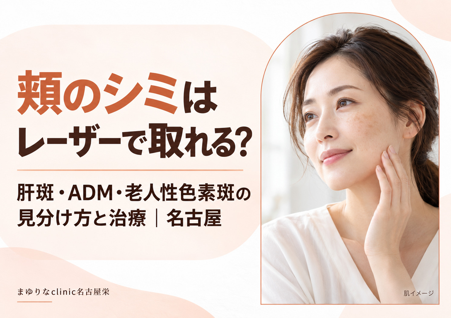 頬のシミはレーザーで取れる?肝斑・ADM・老人性色素斑の見分け方と治療|名古屋
