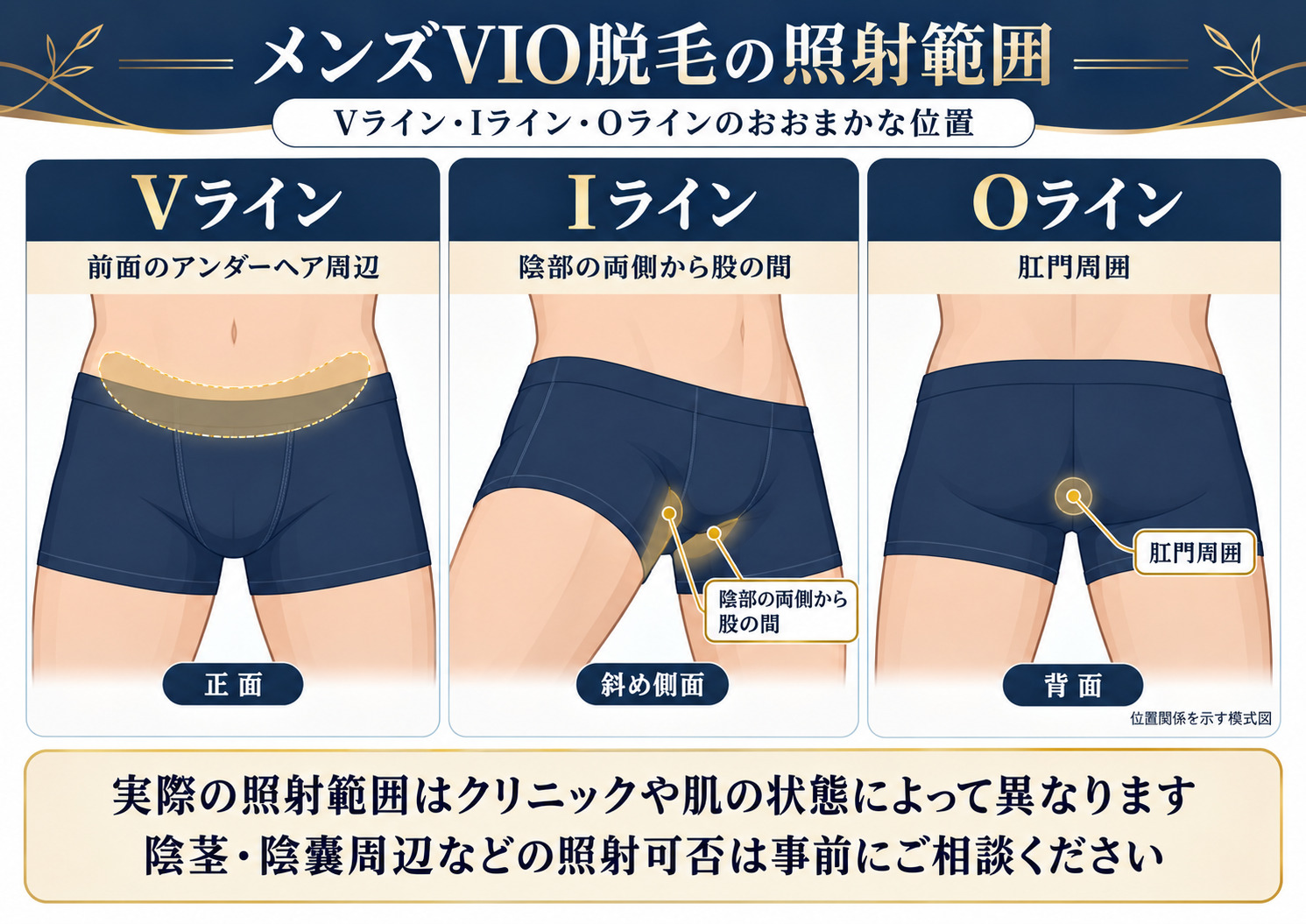 男性のVライン・Iライン・Oラインの位置関係と、医療脱毛の照射範囲を確認する際の注意点を示した図